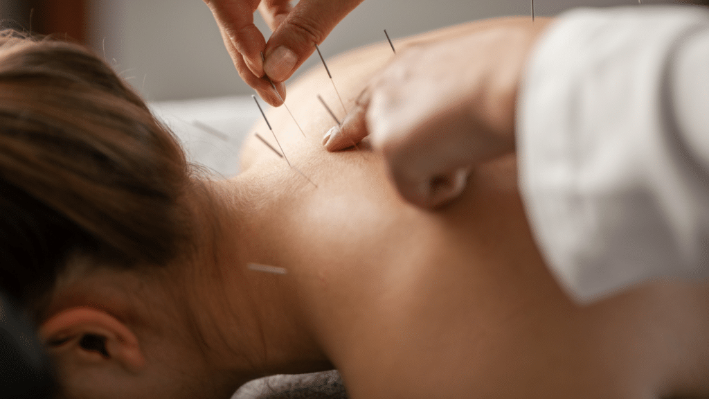 A young woman getting an acupuncture treatment on her back. She is lying face down on the bed.