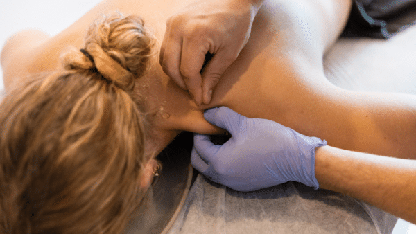 Benefits of Dry Needling for Post-Workout Muscle Recovery